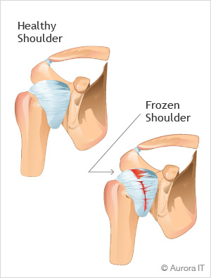 Frozen Shoulder Treatment New York