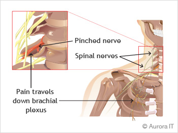 Pinched cervical nerve treatment in NYC